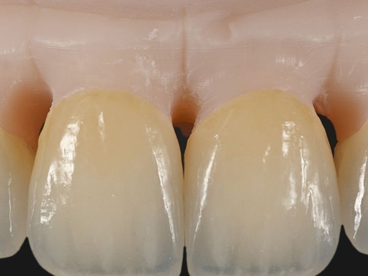 Close-up of four e.max anterior crowns