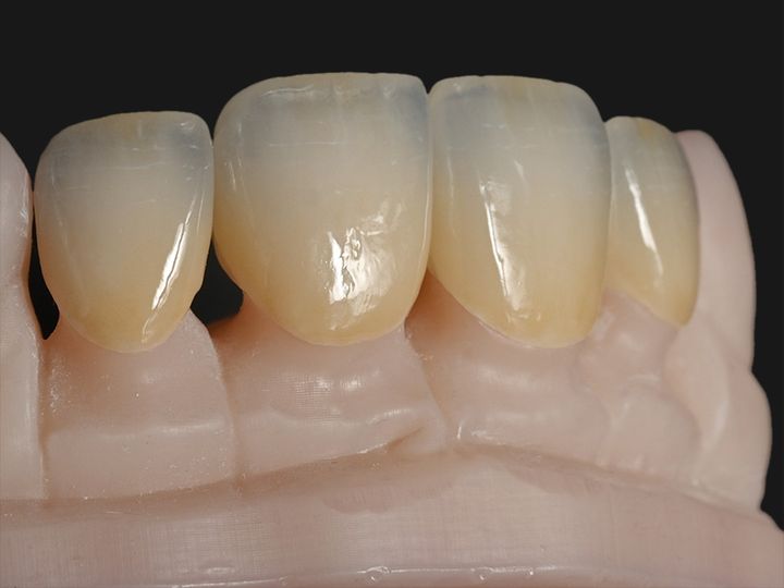 Four anterior e.max crowns on a model