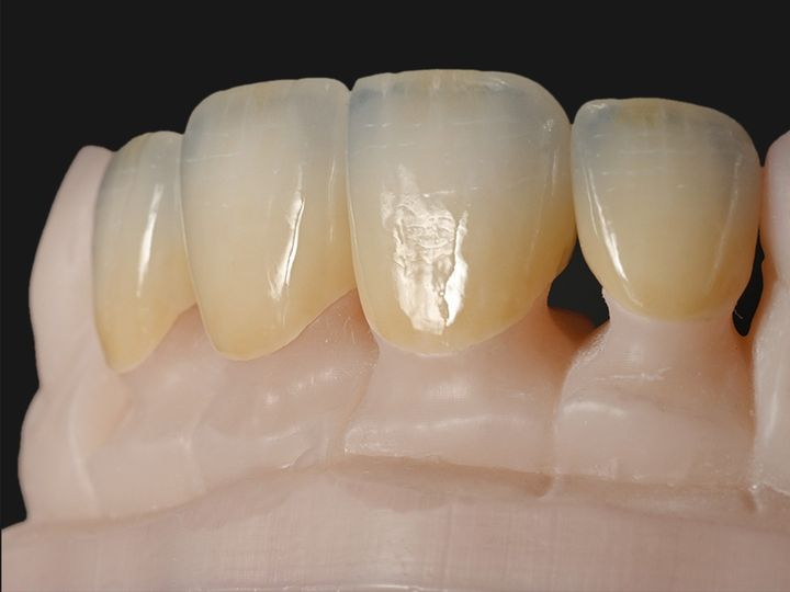 Layered e.max anterior crowns on a model