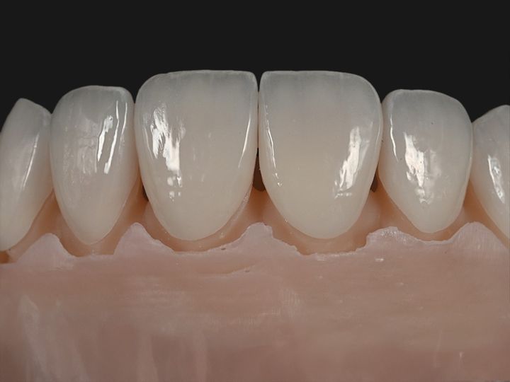 Natural-looking e.max veneers on a model