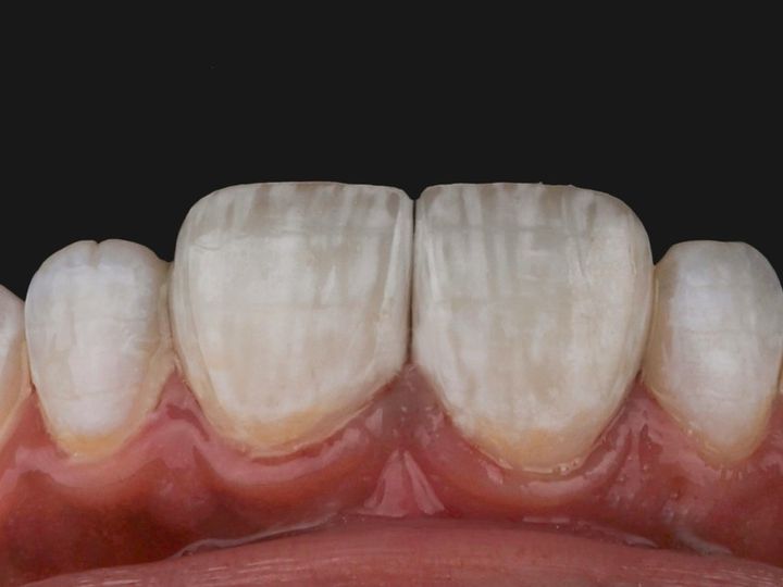Before and after photos of a single central restoration