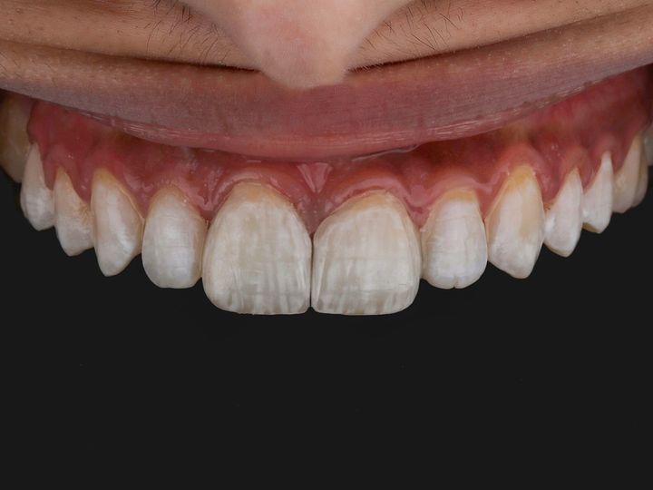 Smile after a single central restoration
