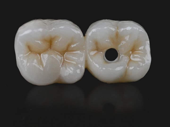 Two splinted posterior crowns with detailed anatomy and stains
