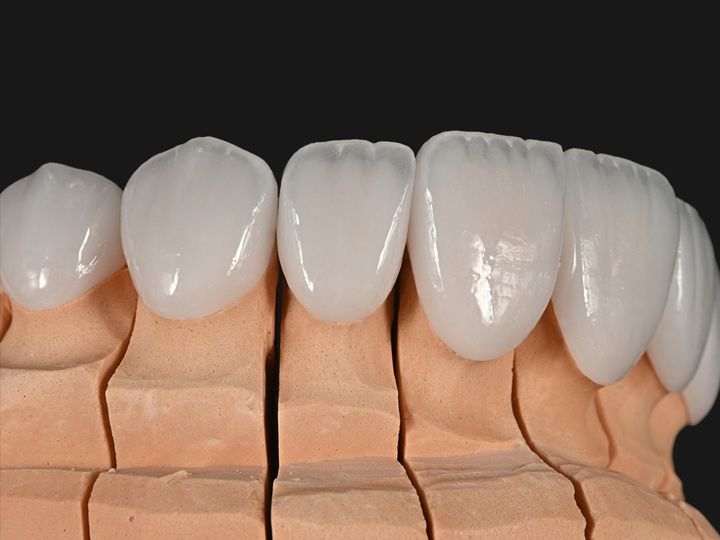 e.max veneers with strong incisal translucency on a model