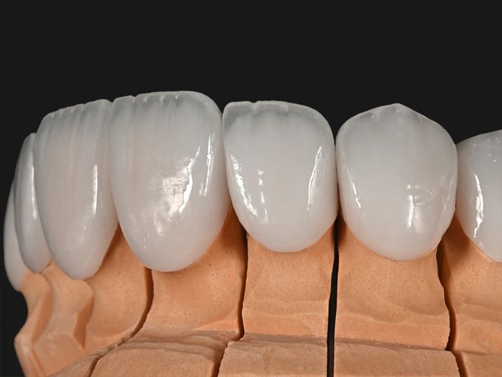 Full arch of e.max veneers on a model