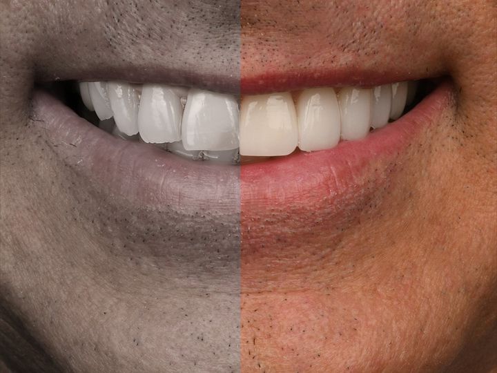 A smile split down the middle, before on one side and after on the other