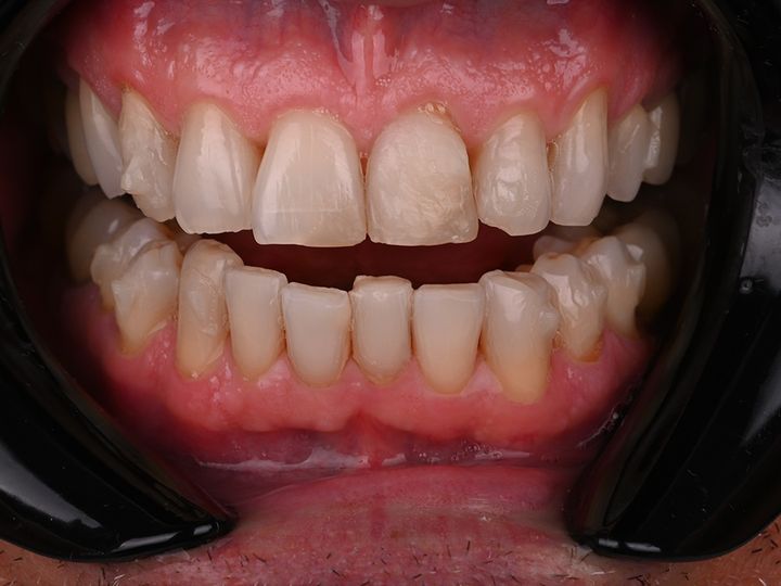 Retracted intraoral view of the finished upper restorations