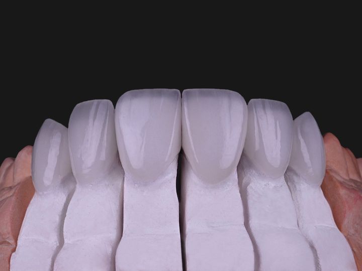 Six feldspathic veneers seated on their dies