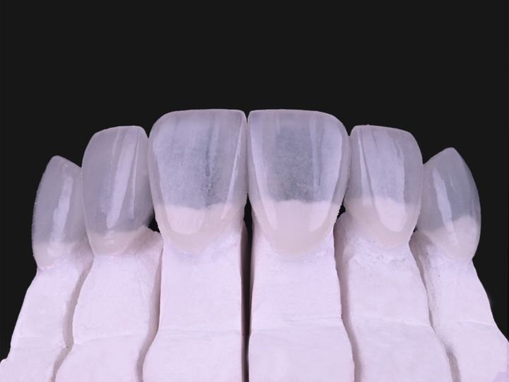 Six thin feldspathic veneers standing on a white model with the dies removed