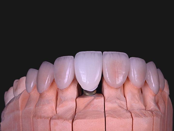 Upper veneers and an implant central seated on a model