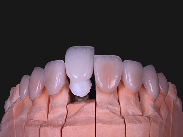 An implant crown on a zirconia abutment beside feldspathic veneers on a model