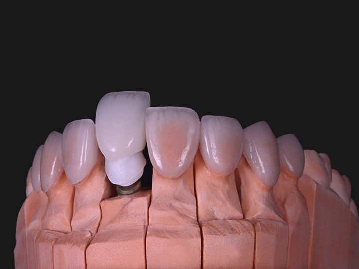 Custom zirconia abutment and crown beside veneers