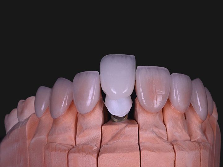 The implant crown and veneers on a model, another angle