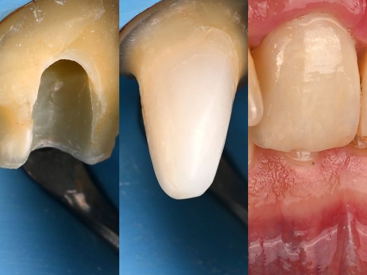 Three clinical photos of a single central from preparation to final crown