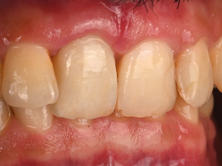 Clinical photo of a single central crown matching its neighbours