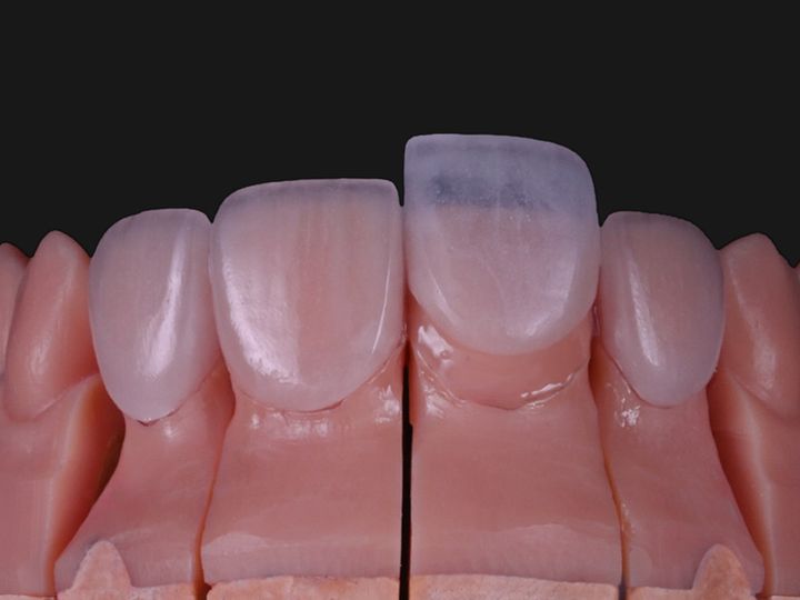 Four upper feldspathic veneers on a model