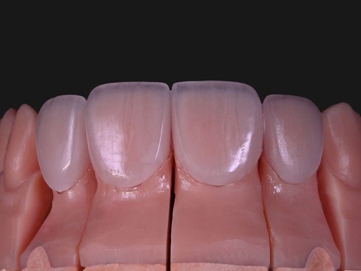 Four feldspathic veneers seated on a model