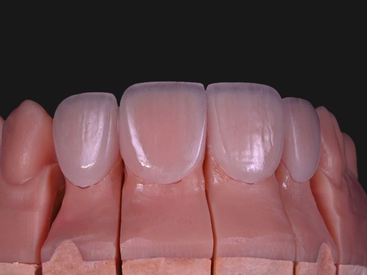 Four feldspathic veneers on a model, another angle