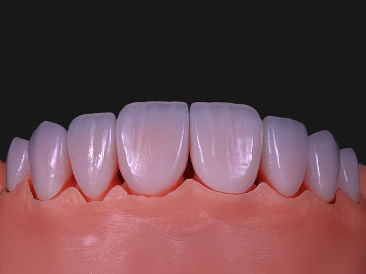 Eight upper e.max veneers on a model