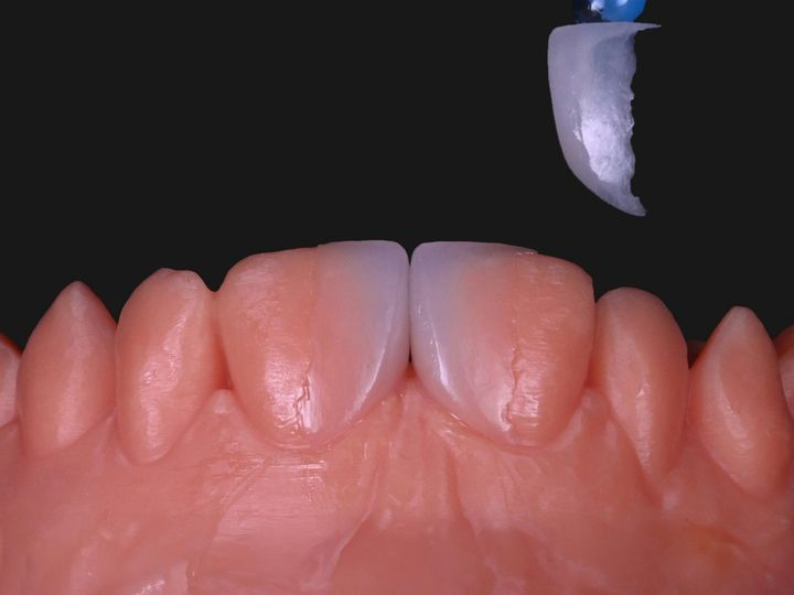 A feldspathic veneer held on a microbrush above a model