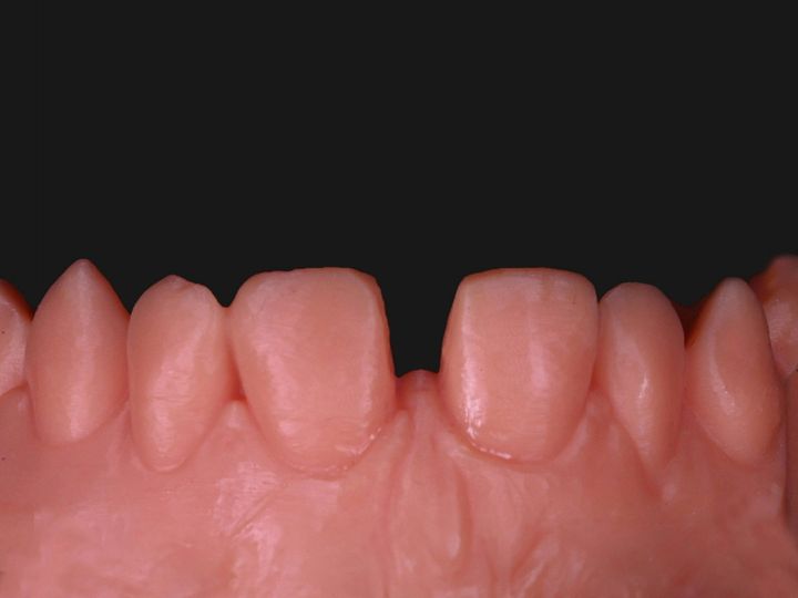 Stone model showing a gap between the upper central incisors
