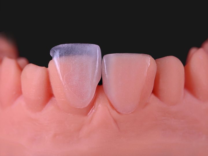Two feldspathic veneers seated on the central incisors of a model