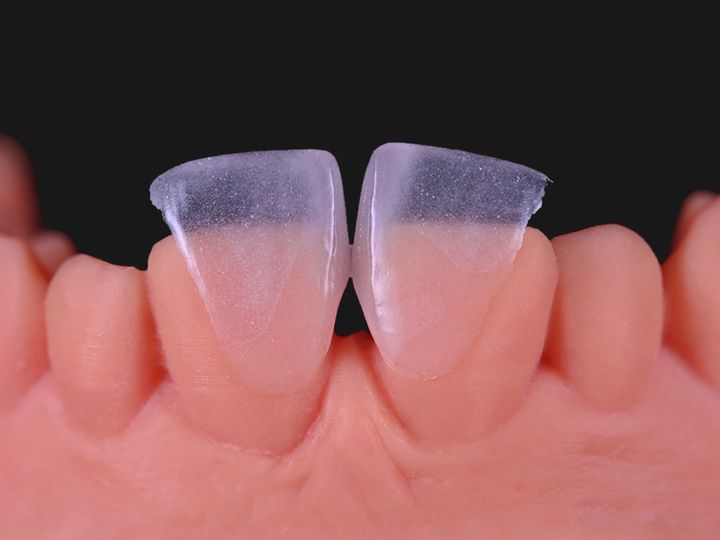 Two thin veneers on the central incisors, closing a gap