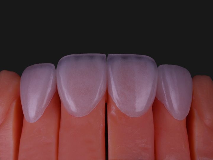 Four upper feldspathic veneers on a stone model